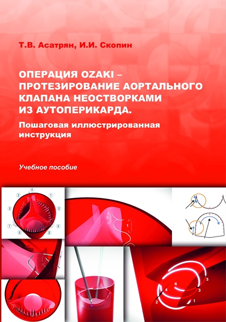Операция Ozaki – протезирование аортального клапана неостворками из аутоперикарда. Пошаговая иллюстрированная инструкция: Учебное пособие